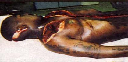 Tupac Shakur Autopsy Photo Tupac Shakur Autopsy Photo